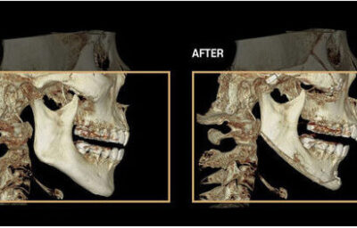 브이라인 수술 전후 CT입니다.