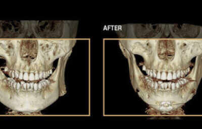 브이라인 수술 전후 CT입니다.