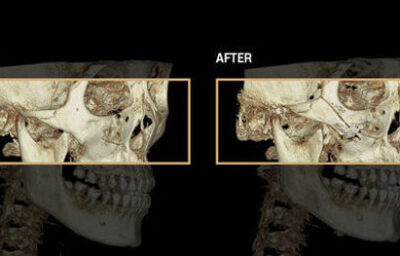 광대수술 전후 CT입니다.