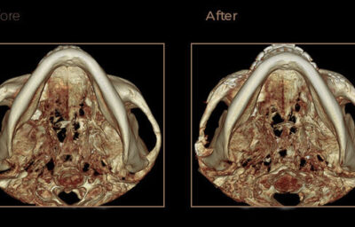 광대수술 전후 CT입니다
